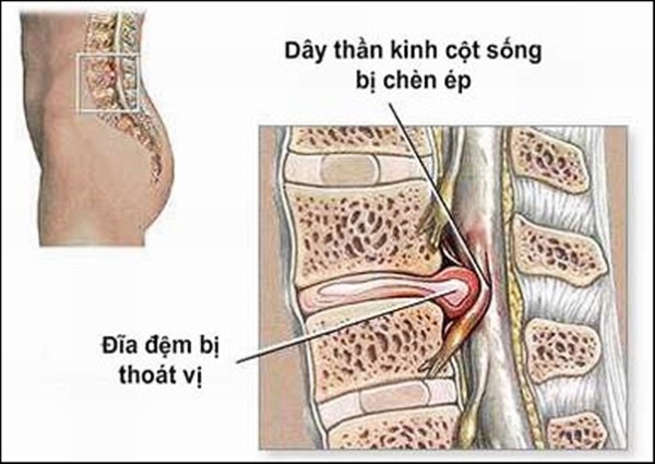 Thoát vị đĩa đệm cột sống thắt lưng gây biến chứng gì?