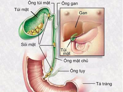 Châm cứu chữa sỏi mật và sỏi tiết niệu