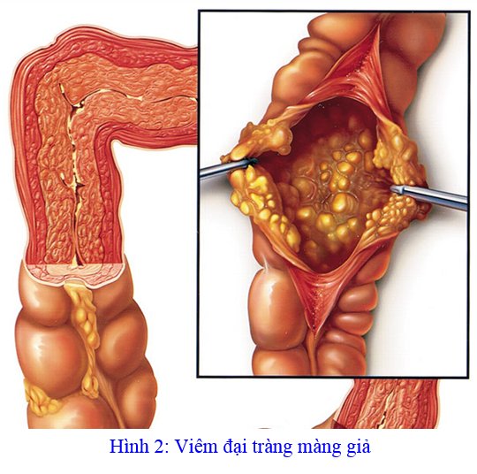 Nhận biết và xử trí viêm đại tràng giả mạc