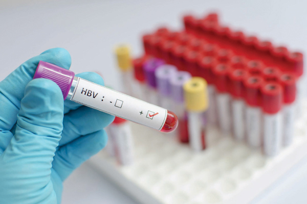 viêm gan siêu vi HBV