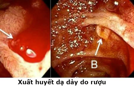 Ðề phòng chảy máu do viêm loét dạ dày - tá tràng