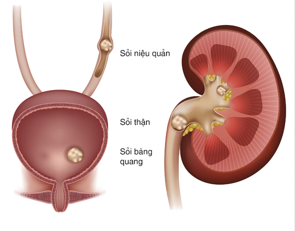 Sỏi thận có thể gây nhiều biến chứng nguy hiểm