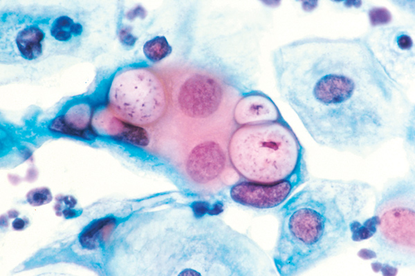 Nhiễm chlamydia trachomatis sinh dục - tiết niệu và những hệ lụy