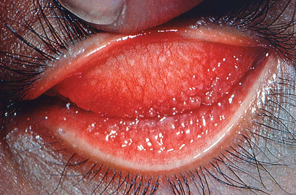 Nhiễm chlamydia trachomatis sinh dục - tiết niệu và những hệ lụy