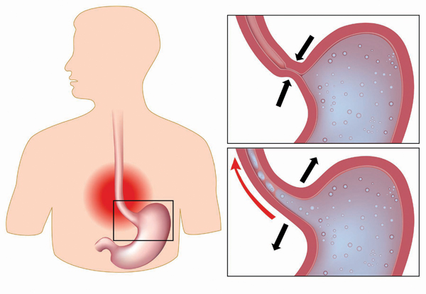 Điều trị trào ngược dạ dày - thực quản