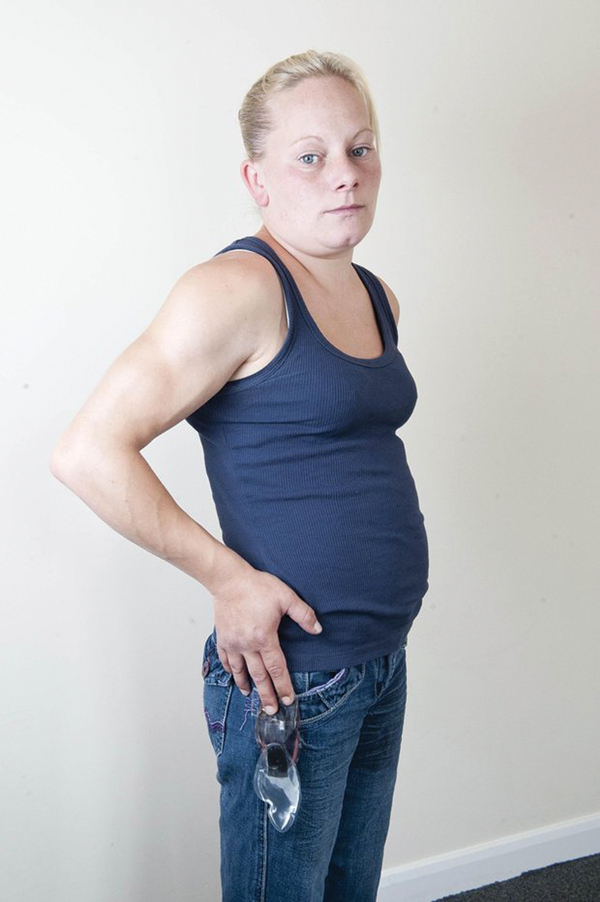 Hội chứng Lipodystrophy biến trẻ thành già, đàn bà hóa đàn ông