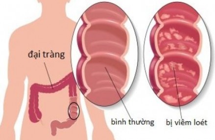 Hạn chế chứng tiểu đêm