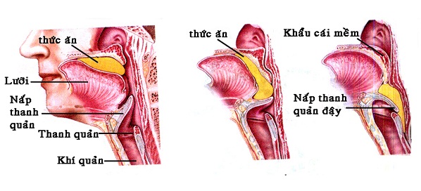 Nuốt nghẹn và cách cấp cứu tránh tử vong