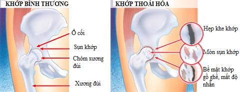 thoai khoa khop o nguoi gia