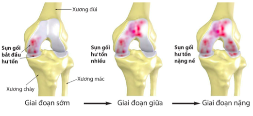 thoai khoa khop o nguoi gia