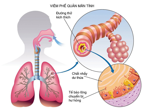 Phòng bệnh viêm phế quản mạn tính