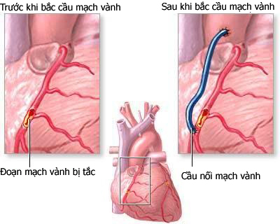 Cầu cơ mạch vành là gì? Tìm hiểu nguyên nhân, triệu chứng và điều trị