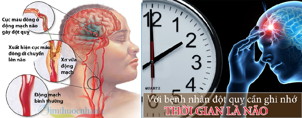 “Giờ vàng” giúp bệnh nhân đột quỵ thoát hiểm