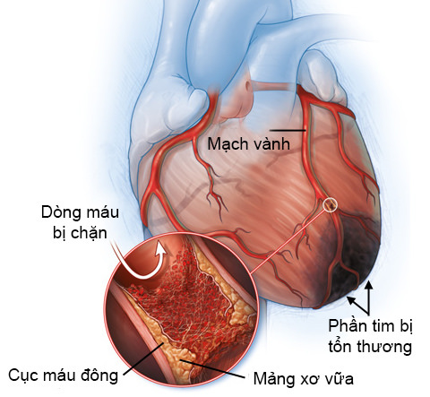 Nhồi máu cơ tim cấp nguy hiểm thế nào?