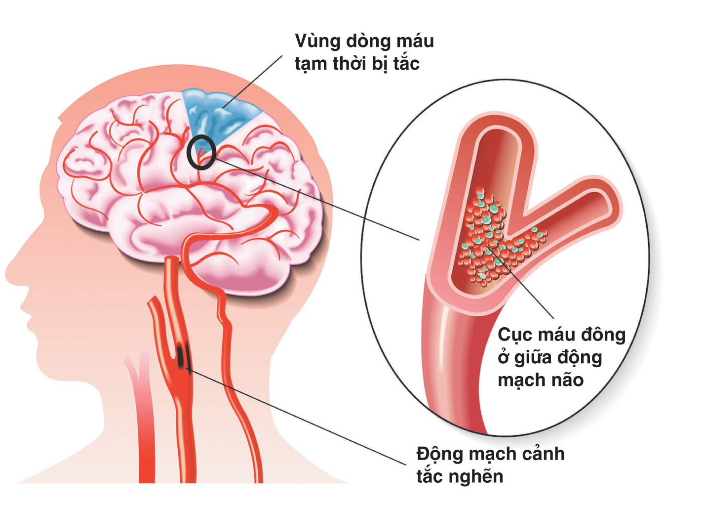 3 bệnh lý mạch máu nguy hiểm không thể bỏ sót