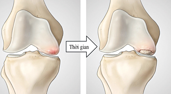 Phòng bệnh xương khớp lúc chuyển mùa