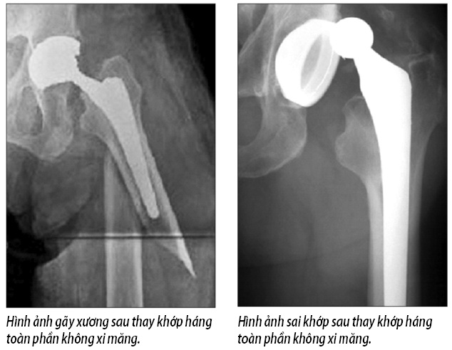 Khắc phục chứng đau sau thay khớp háng