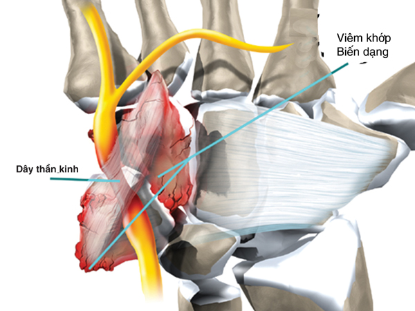 Teo cơ bàn tay do hội chứng đường hầm xương trụ