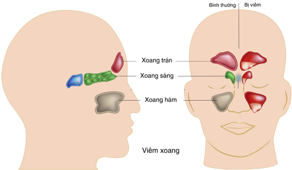 Viêm mũi, xoang dị ứng dễ tái phát khi chuyển mùa