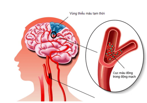 Rối loạn tiền đình