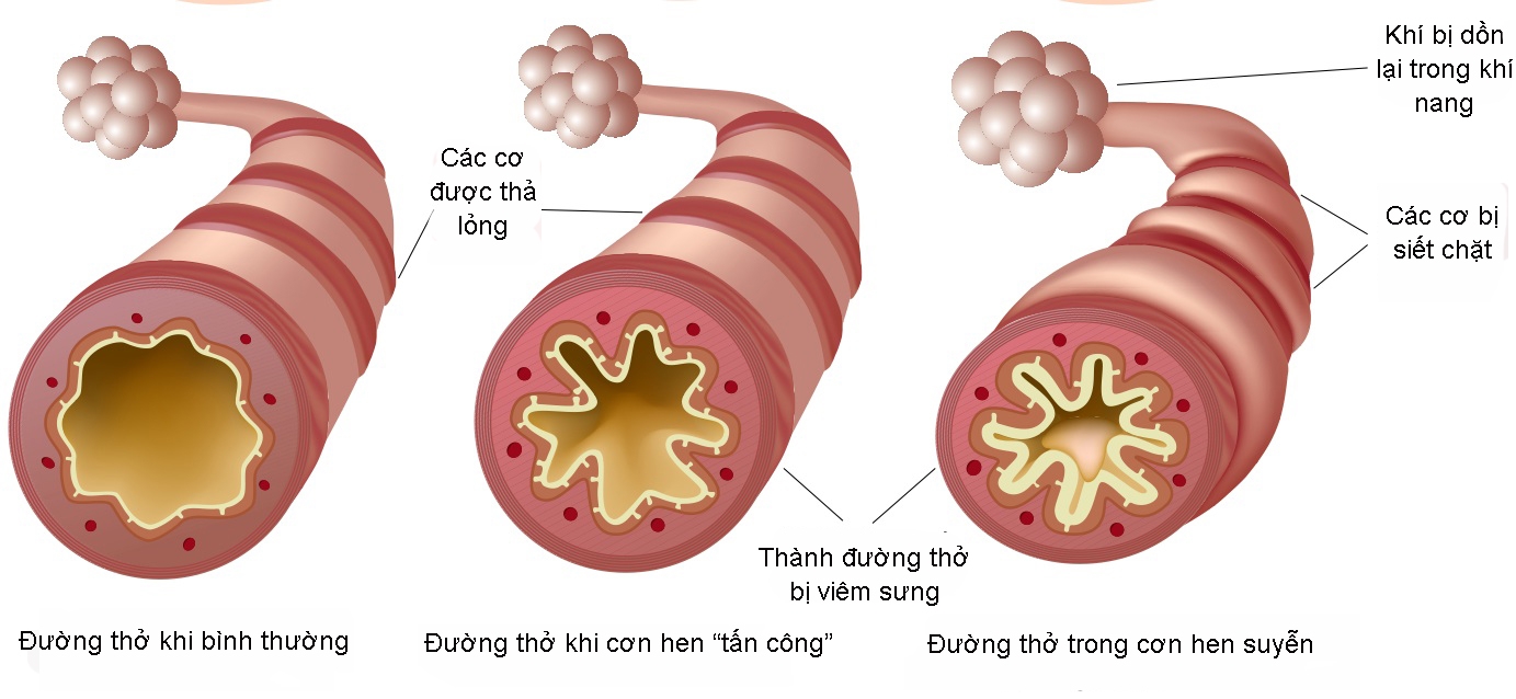 Cách chặn hen suyễn trong mùa lạnh