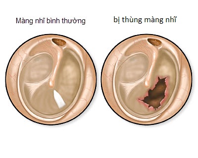 Viêm tai giữa cấp và hệ lụy