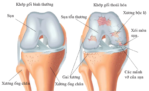 Thuốc dùng trong  thoái hóa khớp