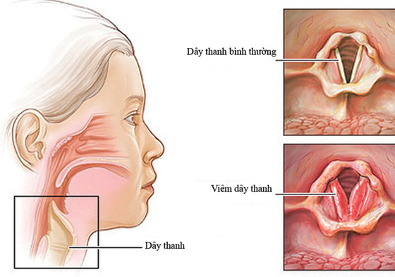 Cách phòng viêm thanh quản