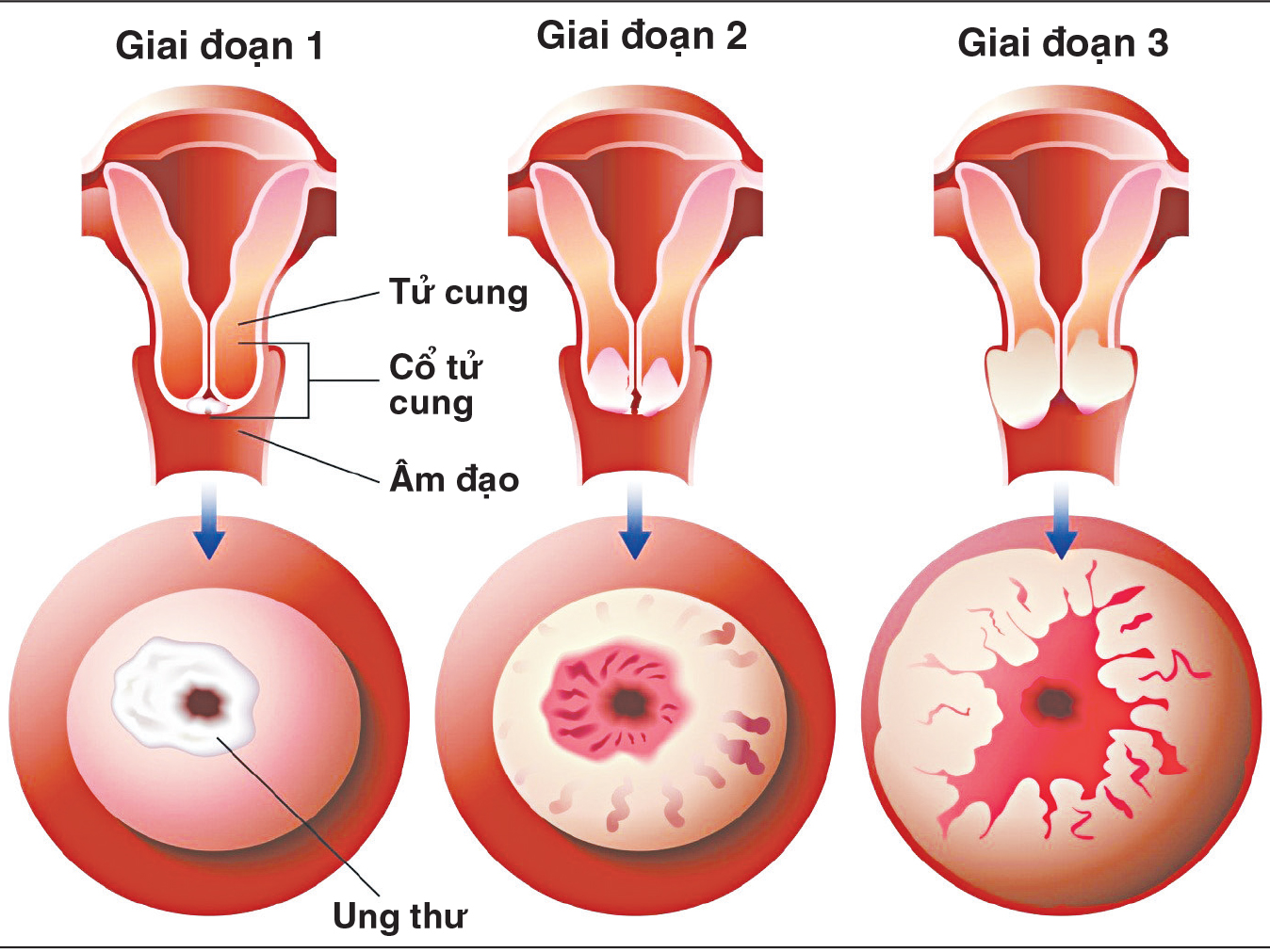 Xét nghiệm đọc tế bào 2 lần tầm soát ung thư cổ tử cung