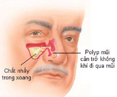 Polyp mũi có nguy hiểm?