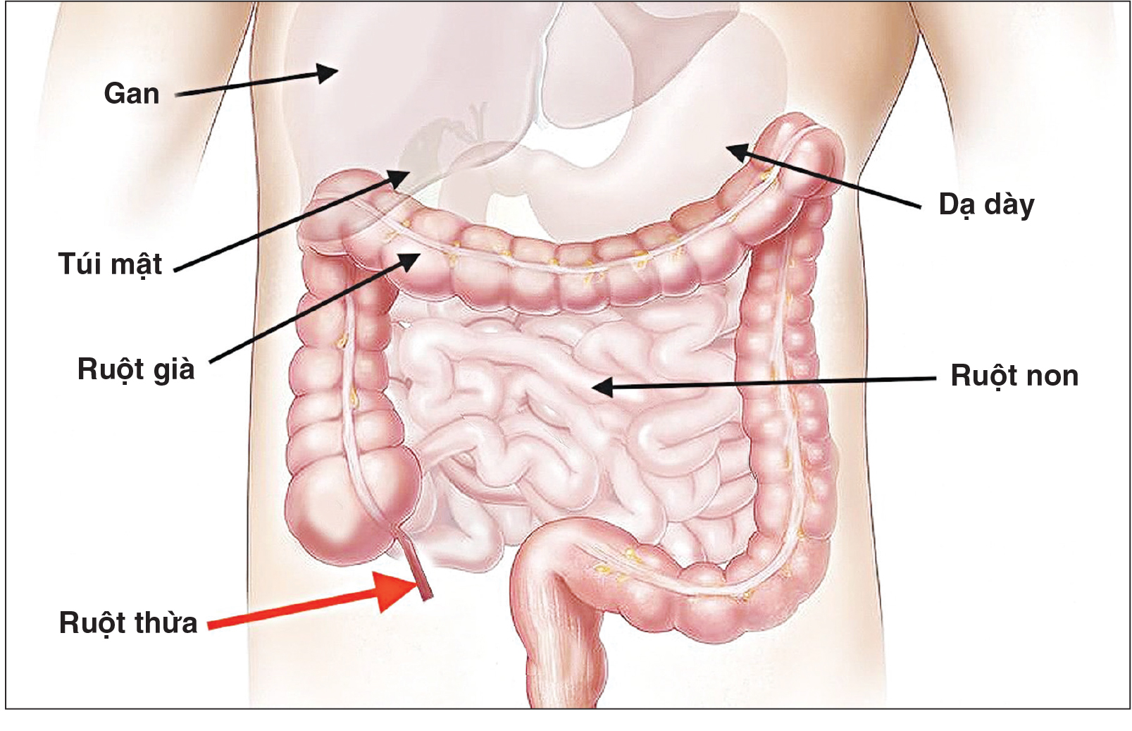 Những biến chứng nguy hiểm do viêm ruột thừa