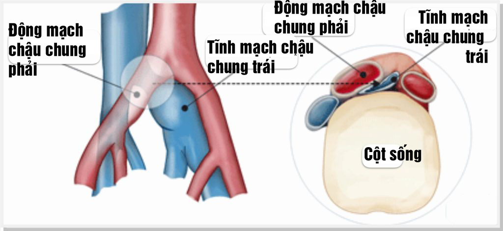 Suy tĩnh mạch chi dưới do hội chứng chèn ép tĩnh mạch chậu