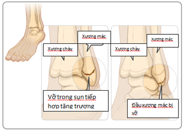 Coi chừng rạn xương khi dùng thuốc trị nôn trớ cho trẻ