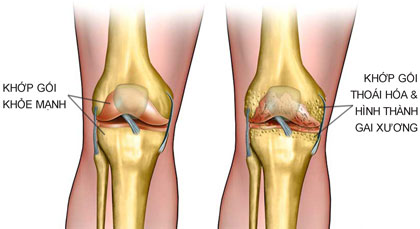 Nguyên nhân nào gây thoái hóa khớp?
