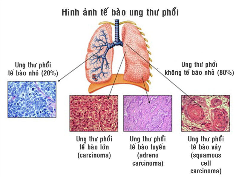 Biện pháp mới trong điều trị ung thư phổi