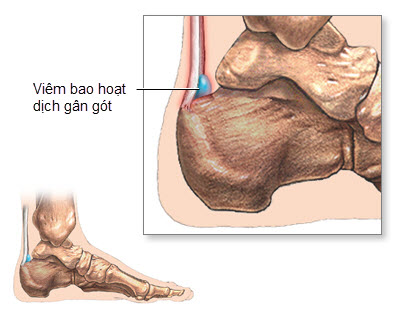 Viêm bao hoạt dịch có nguy hiểm?