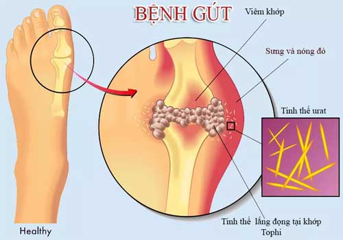 Ứng phó với bệnh gout