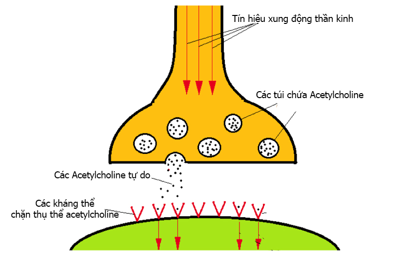 Bệnh nhược cơ có chữa được không?