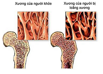 Loãng xương cần được phát hiện và điều trị sớm