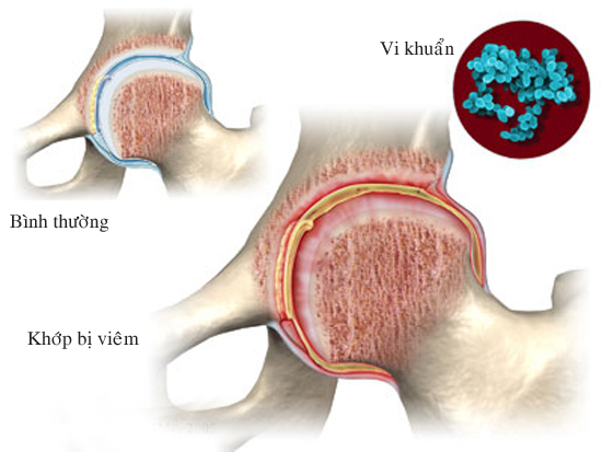 Cảnh giác với biến chứng của viêm khớp nhiễm khuẩn