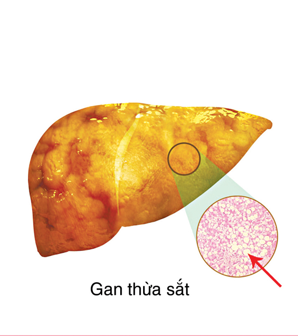 Tác hại khi thừa sắt