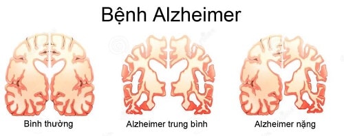 Lưu ý khi chăm sóc người mắc bệnh Alzheimer