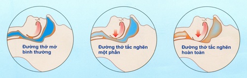 7 hội chứng giấc ngủ nguy hiểm