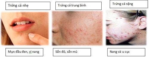 Mụn trứng cá 