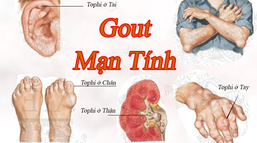 Bệnh gút ngày càng gia tăng và khó điều trị, tại sao?