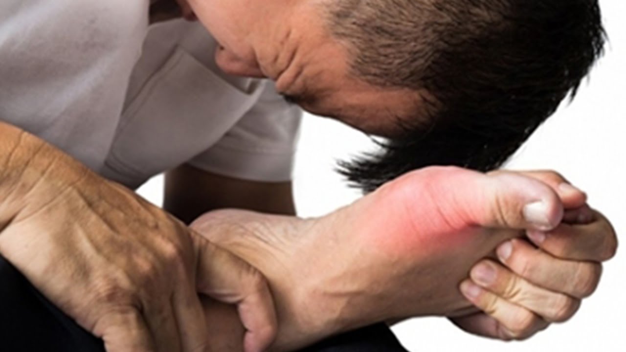 Bệnh gút ngày càng gia tăng và khó điều trị, tại sao?