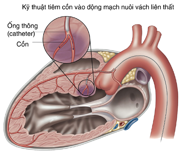 Các tiến bộ trong tim mạch can thiệp