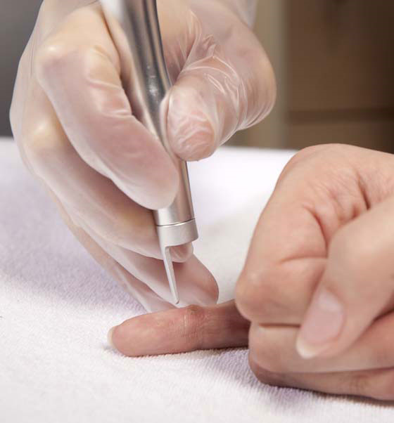Ứng dụng laser trị các dạng rối loạn tăng sắc tố ở da