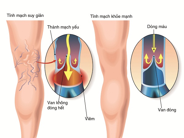 Viêm tắc tĩnh mạch chi và bài thuốc trị