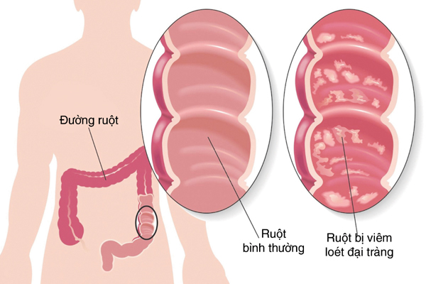 Đối phó với  viêm đại tràng